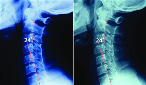 A Cervical Radiographs Showed A Slightly Straightened Cervical Spine