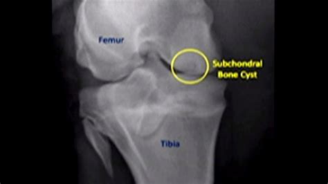 Subchondral Degenerative Cysts Subchondral Bone Cyst Symptoms Causes