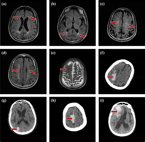 Early Mri Imaging And Follow Up Study In Cerebral Amyloid Angiopathy