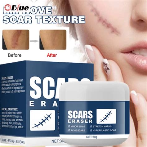 Oblue Scar Removal Cream For Burn Repair And Scar Fading Face Skin