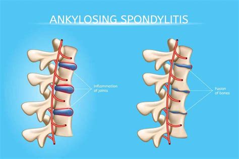 Information About Ankylosing Spondylitis Blackberry Clinic Blog