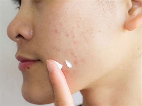 Is It Possible To Treat Acne Scars At Home