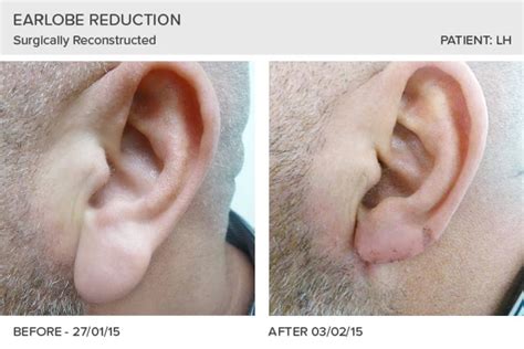 Earlobe Reconstruction Testimonials Skin Surgery Clinic Leeds