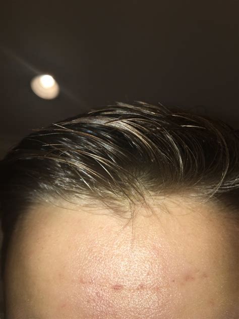 Granted, there's not much you can do about genetics and aging—however, there are more than a few ways you can the key to preventing that breakage along the hairline is to take a breather from daily heat styling and make sure you're not physically tearing or. 16 Years Old. Is My Hairline Receding? Please Help ...