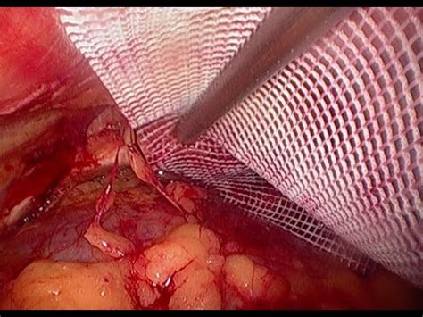 Laparoscopic Paraumbilical Hernia Mesh Repair YouTube
