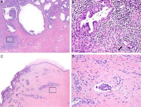 Invasive Human Papilloma Virus Associated Adenocarcinoma Pattern B