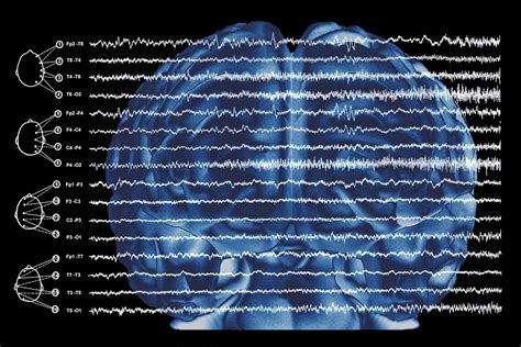 The Bi Directional Association Between Dementia And Epilepsy