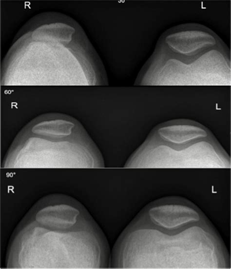 Conventional Skyline View Radiographs Displaying Right Sided Trochlear