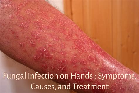 Fungalinfectiononhands Candida Treatment