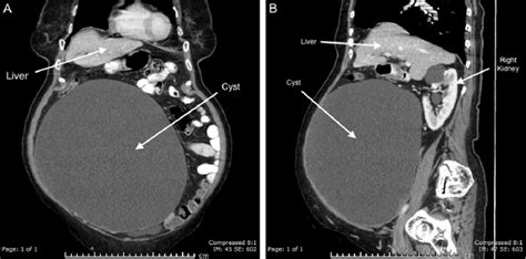 Ct Abdomen With Iv And Oral Contrast A Coronal And B Sagittal