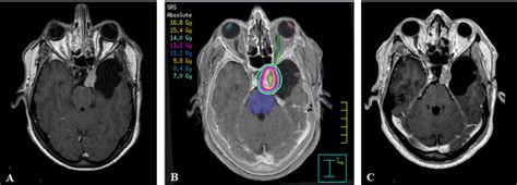 Recurrent Benign Meningioma In A 47 Years Old Male Previously Treated