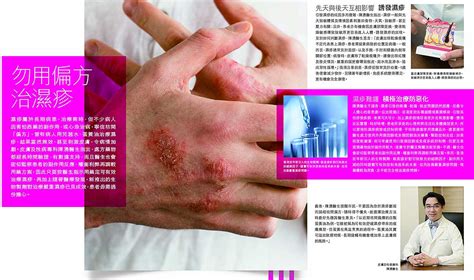 Eczema Atopic Dermatitis Biologics Dupilumab Hong Kong