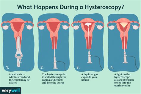 How Do You Prepare For A Hysteroscopy