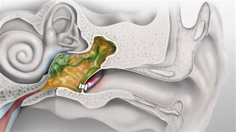 How To Drain Fluid From Middle Ear Reddit