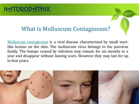 Ppt Molluscum Contagiosum Symptoms Causes Diagnosis T