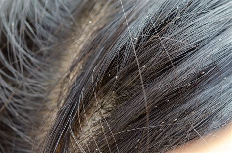 What Lice Eggs Look Like On Hair