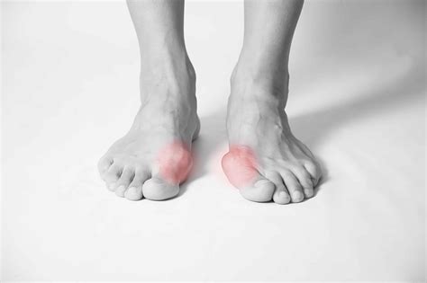 Hallux Limitus Pain Our Podiatrists Can Help Foot Mechanics