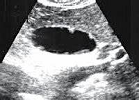 Диета при холестерозе Что такое холестаз желчного пузыря Что такое холестаз желчного пузыря Диета при холестерозе