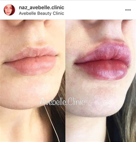 Lip Filler Before And After Lip Fillers Lip Injections Botox Lips