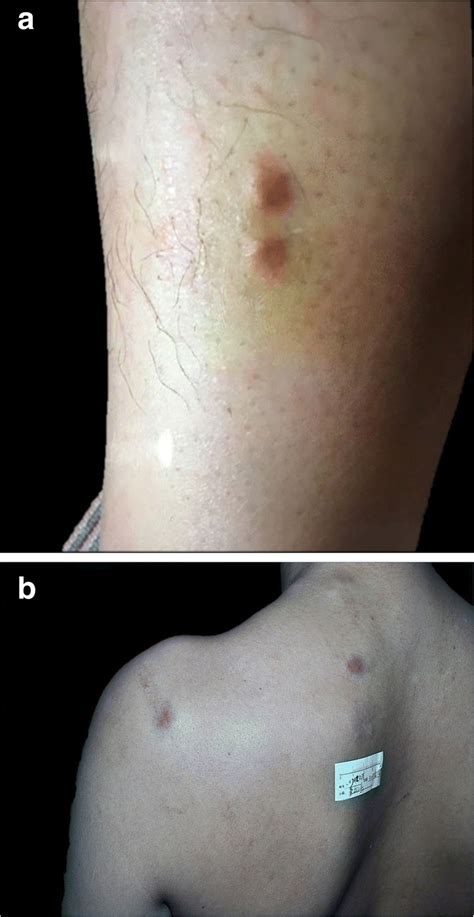 Clinical Presentation Of Pmhe Discrete Erythematous Nodules On The Leg