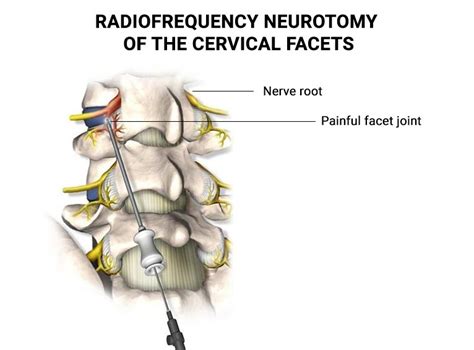 Radiofrequency Neurotomy Of The Cervical Facets The Spine Rehab Group
