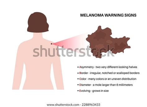 Melanoma Warning Signs Abcde Rule Skin Stock Vector Royalty Free