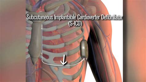 New S Icd Defibrillator A Safety Net For Cardiac Patients Youtube