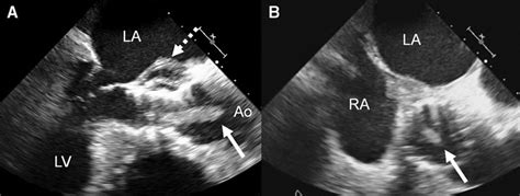 Transcatheter Aortic Valve Endocarditis Confirmed By Transesophageal