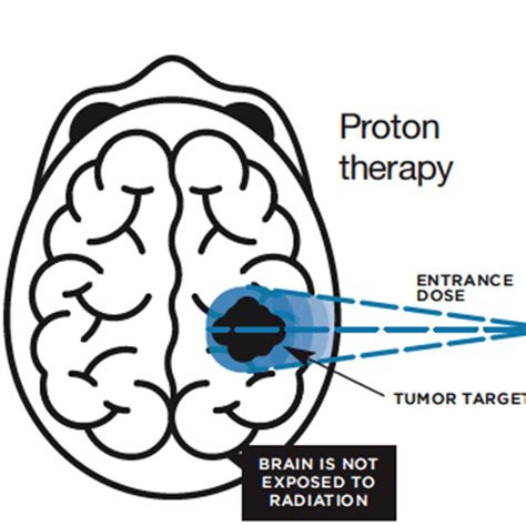 Brain Tumors Johns Hopkins Medicine