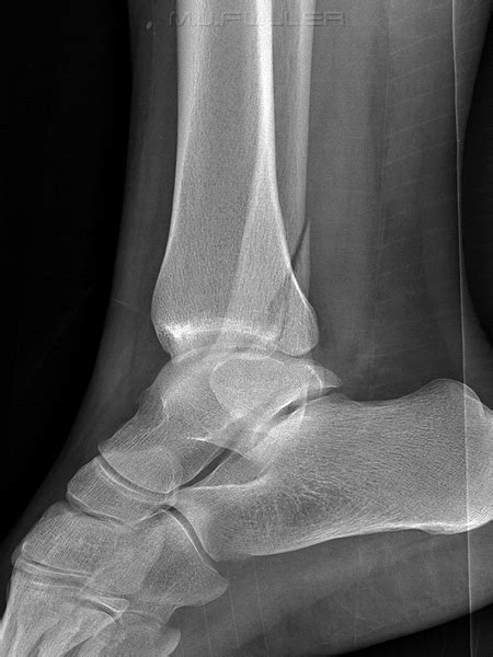 Ankle Trauma 4 Wikiradiography