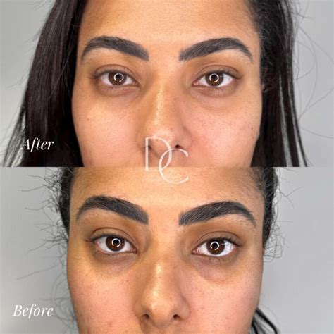 Cosmetic Injectables Before And After Gold Coast Dc Aesthetics