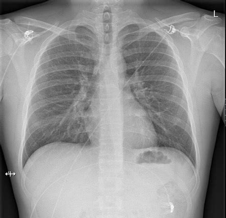 Normal Chest Radiograph Male Radiology Case Radiopaedia Org