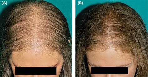 Alopecia AndrogÉnica ¿qué Es Causas Síntomas Tratamiento Y Mucho Más