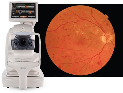 Crstoday The Next Generation Automated Oct And Fundus Imaging System