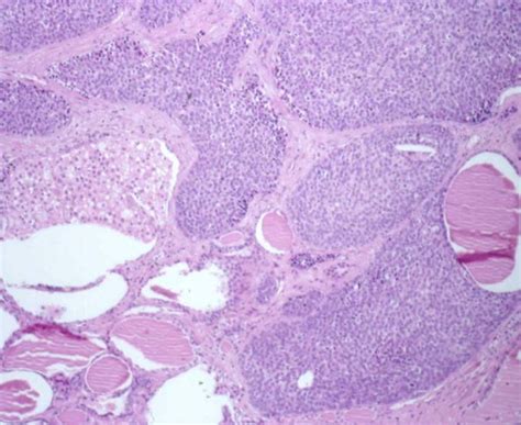 Carcinoma Showing Thymus Like Differentiation Of Thyroid Solid Sheets
