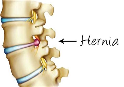 Wat Is Een Hernia Soorten En Behandeling Orthocor Blog