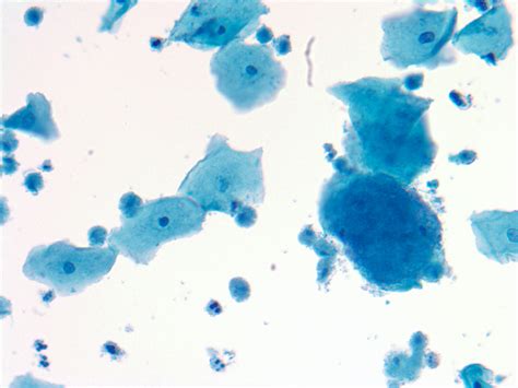 Pathology Outlines Trichomonas Vaginalis