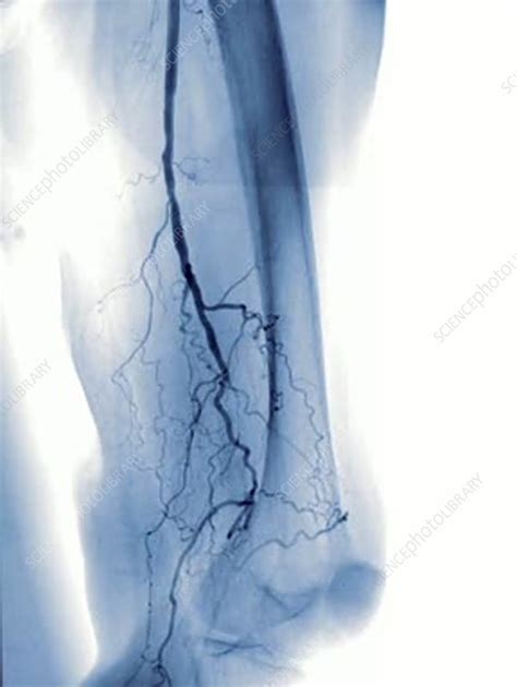 Leg Angiography Stock Video Clip K0029013 Science Photo Library