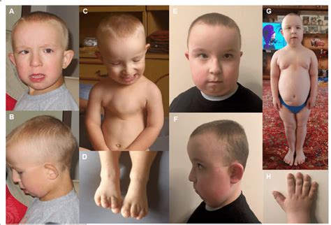 Dysmorphic Features And Changing Phenotype Of Patient 1 At The Age Of 3