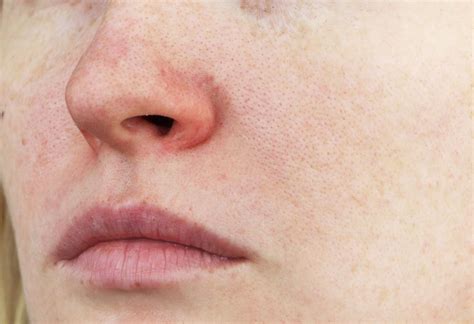 rosacea what it looks like causes and treatment