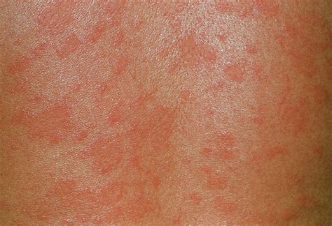 What Is Pityriasis Rosea Skin Hair Problems Medical A
