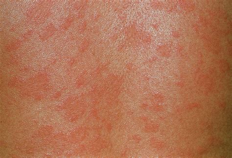 Pityriasis Rosea Pityriasis Rosea Dermnet Nz This Is Then