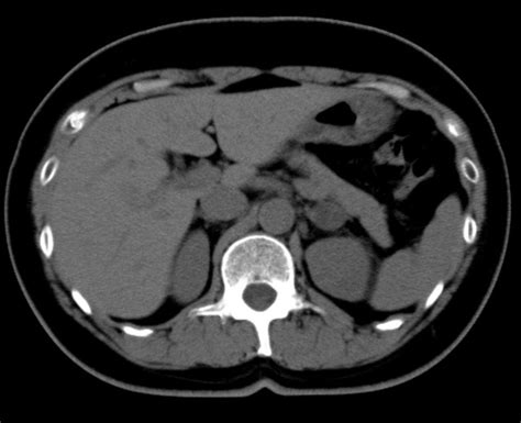 What Is The Contrast Dye Used In Ct Scans And How Does It Work