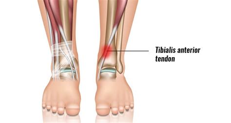 Front leg musclevtendon ~ image result for m. Tibialis Anterior Tendonitis (Tendinopathy) - Symptoms ...