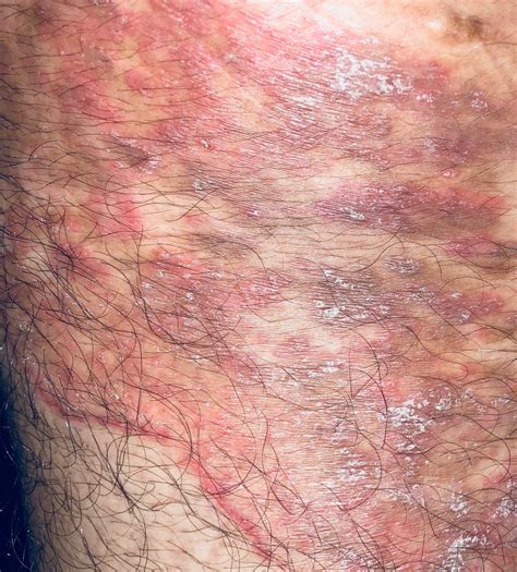 Images Of Ringworm Infection Ringworm Medically Defined As Tinea Is