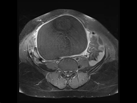 Ovarian Mature Cystic Teratoma Image