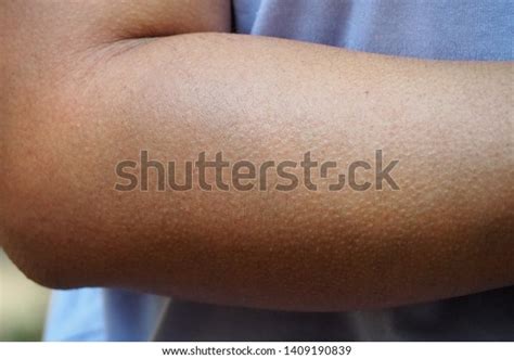 Human Skin Getting Goosebumps On Arm Stock Photo 1409190839 Shutterstock