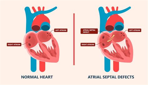Atrial Septal Defect Patent Foramen Ovale Repair Clearwater