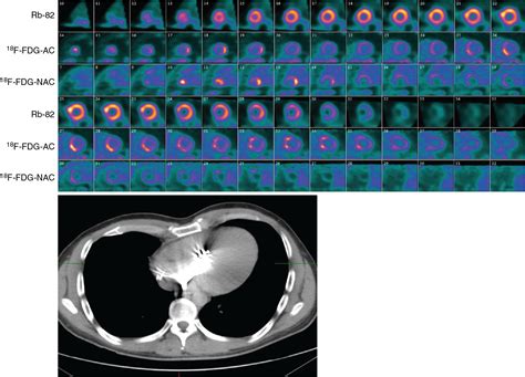 Recognizing And Preventing Artifacts With Spect And Pet Imaging
