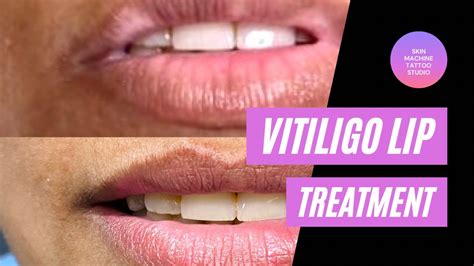 Vitiligo Lip Pigmentations 90 Success Results By Skin Machine Tattoo
